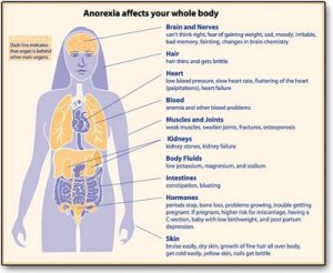 info-anorexia2